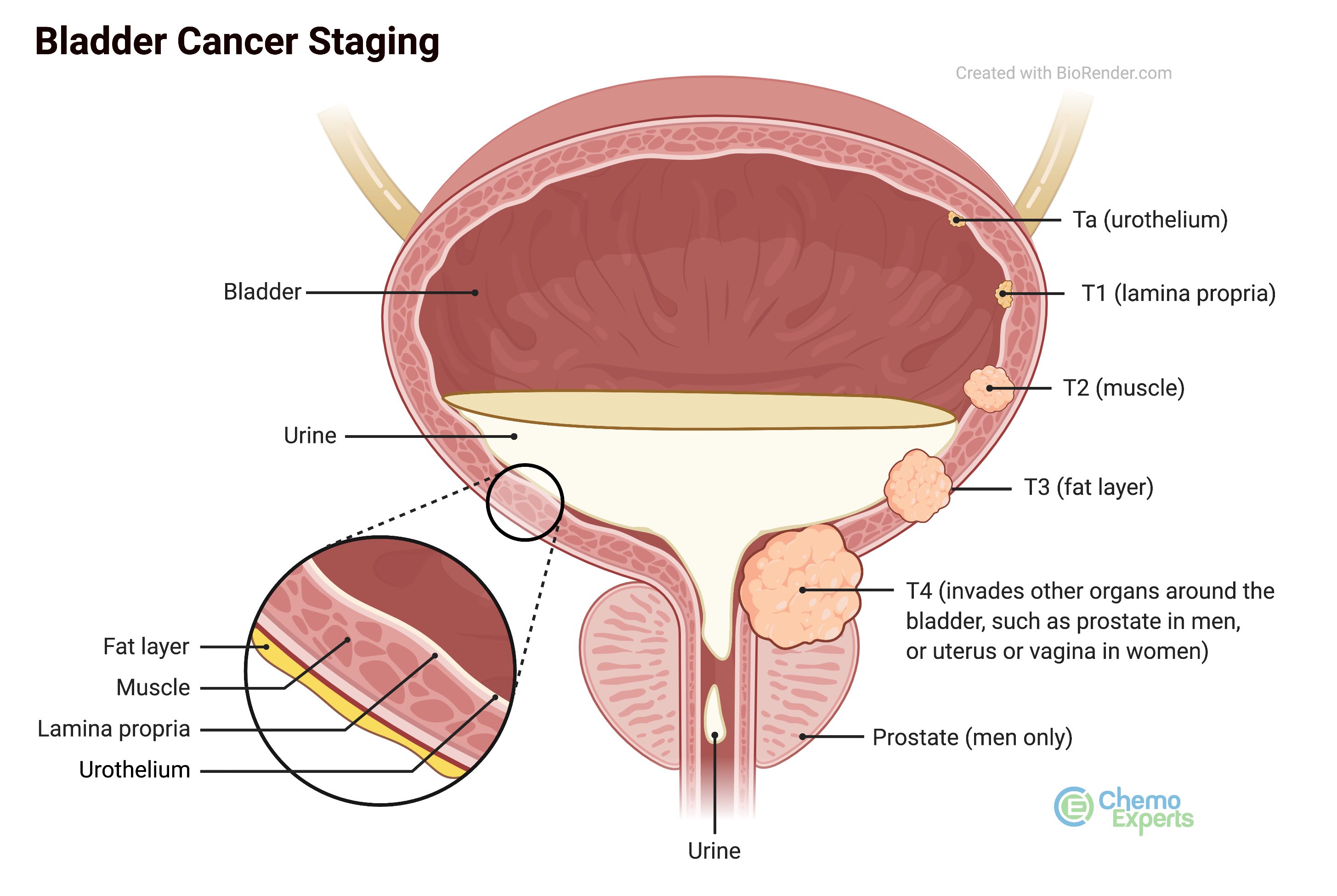 Stages of bladder cancer Ta, T1, T2, T3, T4.jpg
